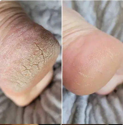 Min hæl før og efter med Lovelle Smooth Pro