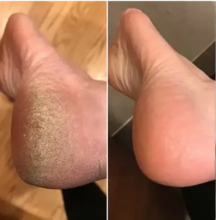 Hæl før og efter med Lovelle Smooth Pro