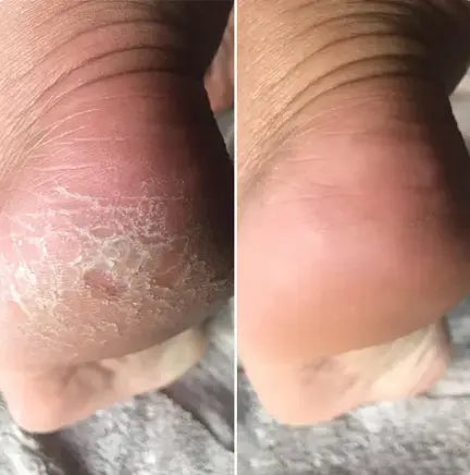 Min hæl før og efter med Lovelle Smooth Pro