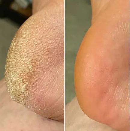 Hæl før og efter med Lovelle Smooth Pro